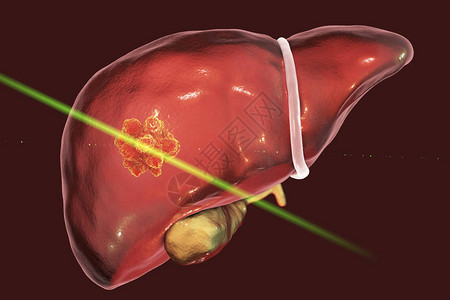 使用激光进行肝癌治疗概念图背景图片