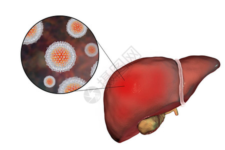 黄病毒肝硬化阶段丙型肝炎感染的肝脏和丙型肝炎HCV3D插设计图片