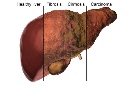 肝炎B和丙型肝炎感染的肝病发率上图片
