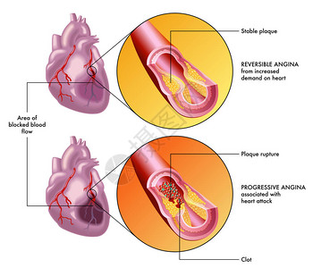 低密度脂蛋白胆固醇递进angin设计图片