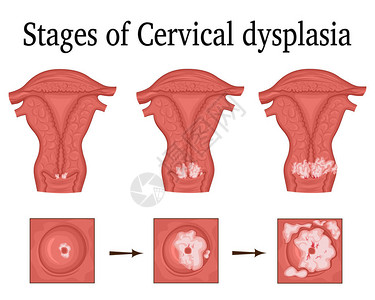 子宫颈痢疾的三阶段一种潜在图片