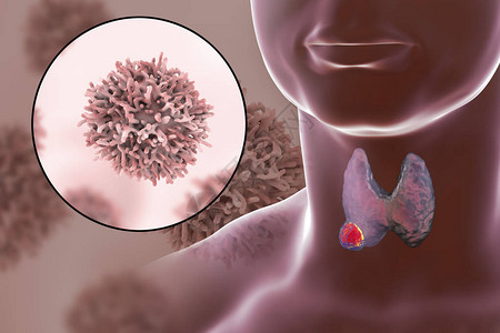 甲状腺癌3D图解显示甲状腺人体内肿瘤和甲状腺背景图片