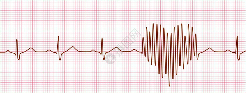 爱的宣言心电图图片