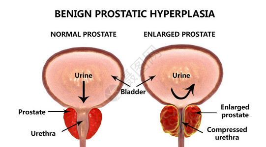 3D图解显示正常和膨胀的前列腺本图片