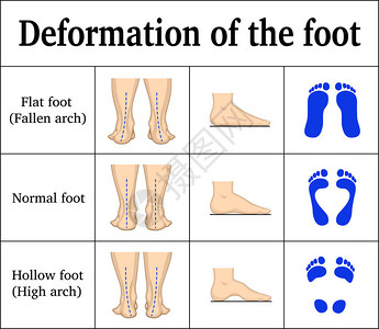 足部变形图解扁平足和空心足有脚印设计图片