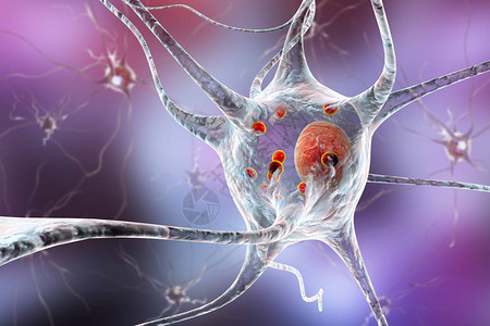 帕金森病3D插图显示含有路易体小红球的神经元设计图片