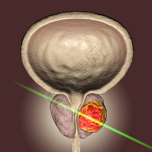 前列腺癌激光治疗概念图图片