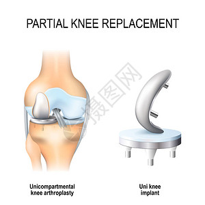 部分膝关节置换术单间室膝关节置换术和单膝关节植入物插画