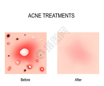 痤疮治疗之前和之后皮肤问题图片
