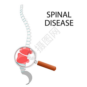 腰椎键盘突出脊柱疾病通过放大镜的腰椎切片人体脊柱突出腰椎的插图插画
