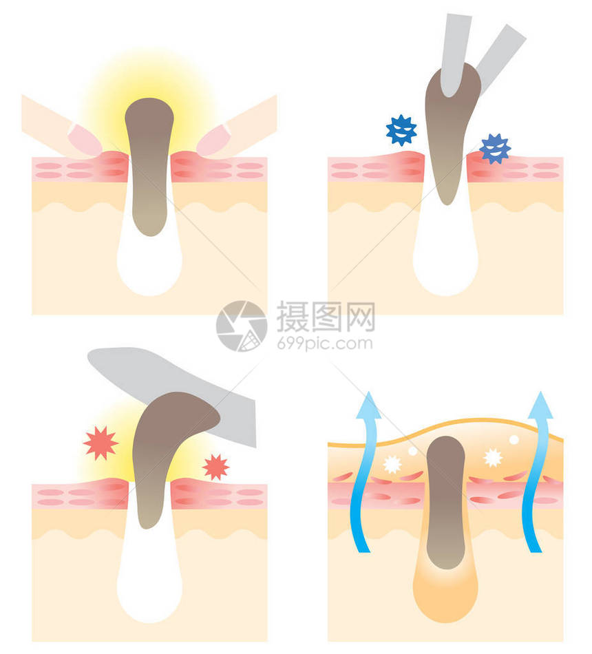 4种方法来解缩孔挤压用树枝抽取撕掉图片