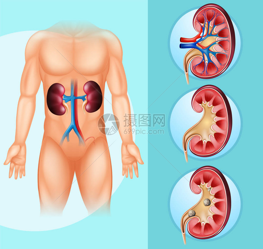 人和肾结石插图图片