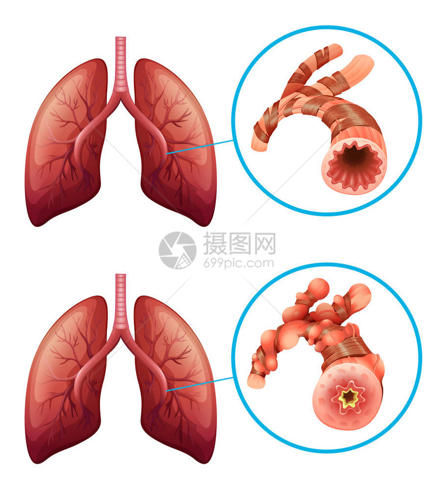 显示肺部疾病插图的表图片