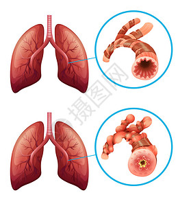 显示肺部疾病插图的表图片