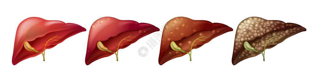 人类肝脏插图的不同阶段图片