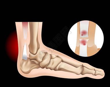 人脚与撕裂肌腱插图图片