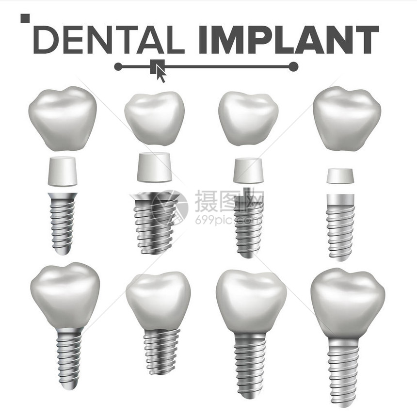 牙种植体集载体植入结构冠图片