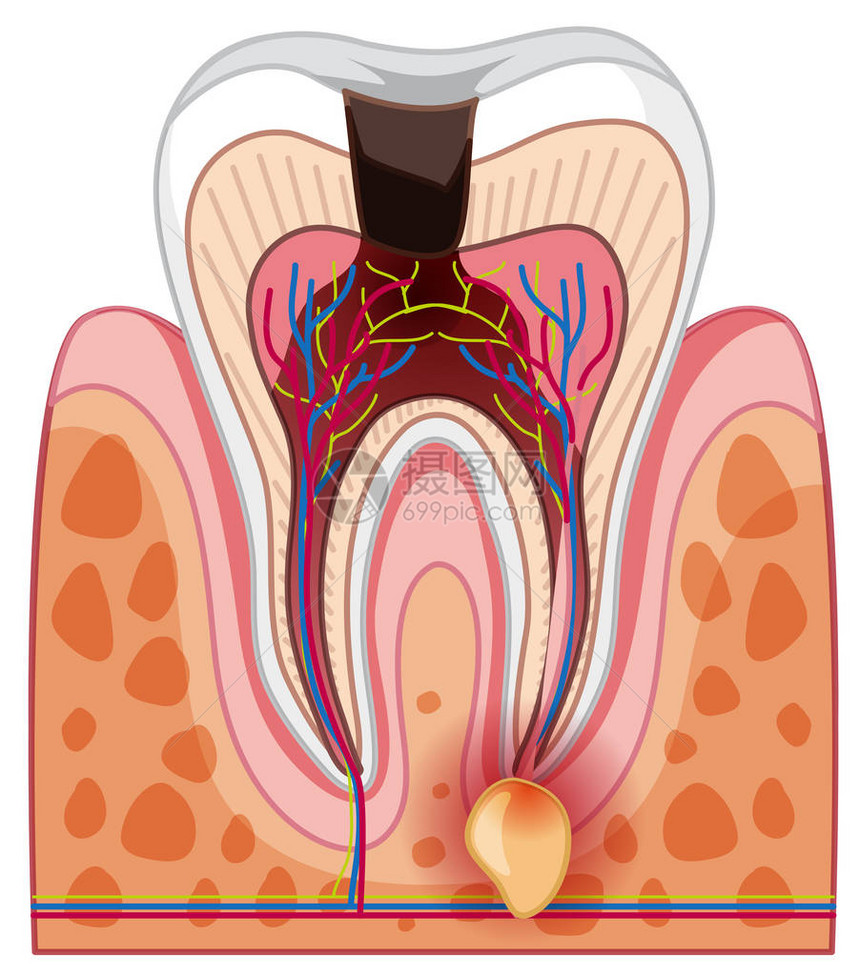 人类蛀牙和蛀牙插图图片