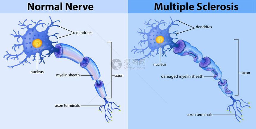 正常神经和多发硬化症插图图片