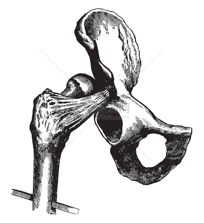此插图代表伊利背脊上的髋关节脱位复古画图片