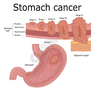 间充质干细胞肿瘤疾病发展的五个阶段胃癌插画