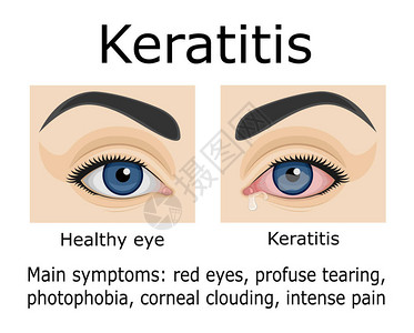 眼科疾病角膜炎的症状说明高清图片
