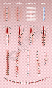 缝合线结扎手术缝合线在透明背景上用不同形状的医用缝合线缝合逼真的图像插画