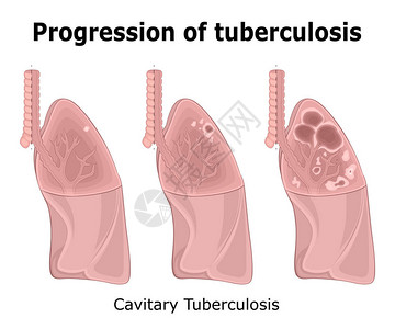 胃肺结核病增速插图CavitalPulturalMultary插画
