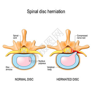 脊椎骨中的正常盘片和脊髓膜损伤图片