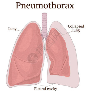 肺部有气胸症状的插图插画