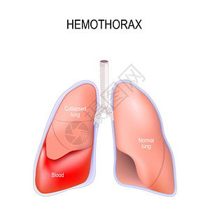气胸血胸肺萎陷肺和胸壁之间的胸膜腔内血液异常聚集用于医学生物科学和教育用插画