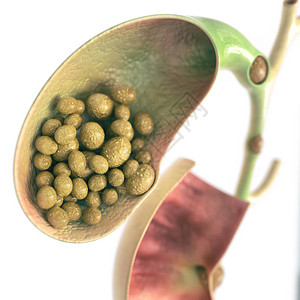 植物神经功能紊乱胆囊和胆管中的胆结石高细节插画