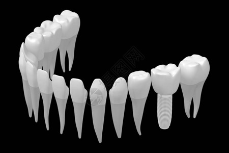 种植牙种植牙图片