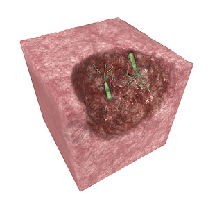 肉丸幽门螺杆菌是一种通常存在于胃中的微需氧细菌它存在于患有慢胃炎和胃溃疡的人身上显微镜下看到的细菌设计图片