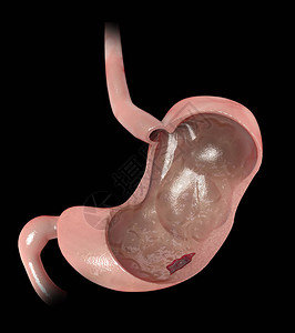 胃肠病胃的第3d部分消化溃疡疾病设计图片