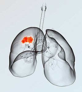 有肿瘤支气管和气管的人类肺轻蓝背景图片