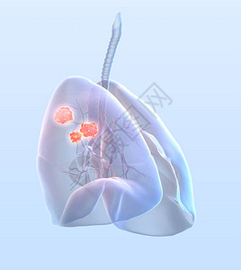 有肿瘤支气管和气管的人类肺轻蓝背景图片