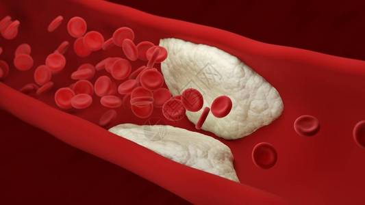 纤维状动脉粥样硬化斑块在动脉内积聚血细胞3d插图设计图片
