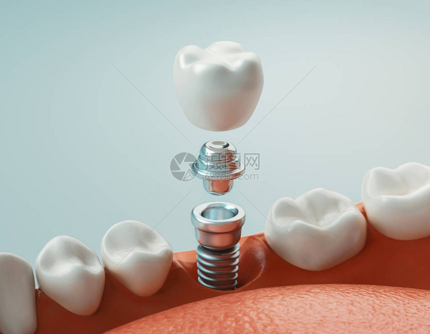 牙科护理牙科植入物图片