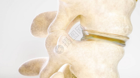 椎管狭窄3D详细显示的特写设计图片