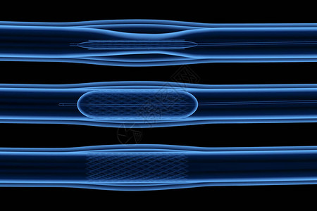 水刺无纺布3d静脉刺塞的X射线气球设计图片