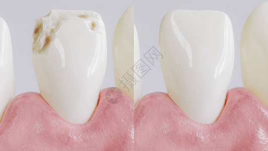 切口后牙齿后牙类处理高清图片