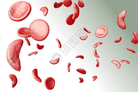 镰状细胞贫血症SCD血背景图片