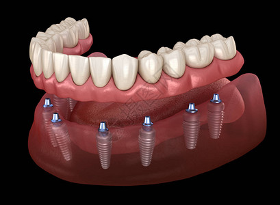 下颌假体Allon8系统由植入物支持人类牙齿和假牙概念的医学上准确的图片