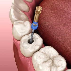牙周肾上腺液管治疗过程医学精确设计图片