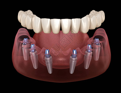 全部6下颌假体Allon6系统由植入物支持人类牙齿和假牙概念的医学上准确的设计图片