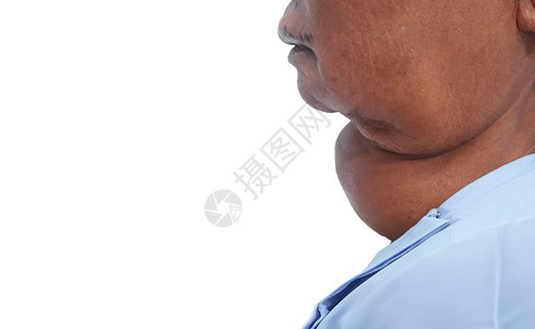 年龄较大的甲状腺在放大近端横向视图中扩大背景图片
