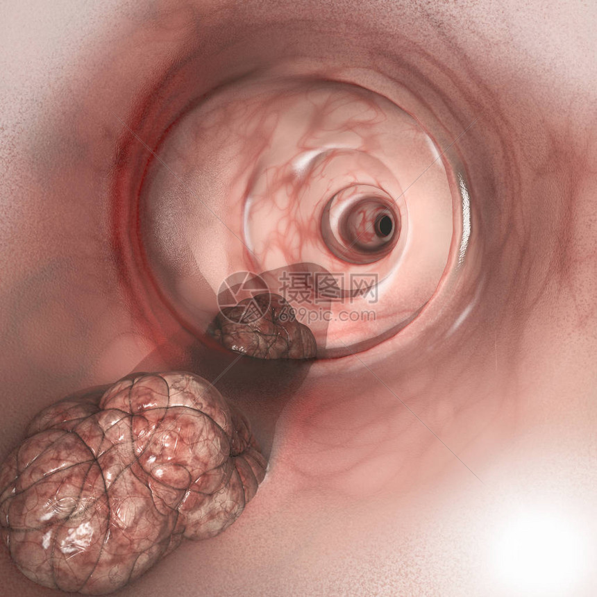 肠壁的内部视图结直肠癌CRC肠癌结肠癌或直肠癌侵入或扩散到身体其他部位的细胞异常生长图片