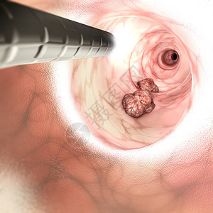 结肠炎肠壁的内部视图结直肠癌CRC肠癌结肠癌或直肠癌侵入或扩散到身体其他部位的细胞异常生长设计图片