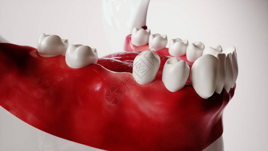牙齿植入图片系列11图片